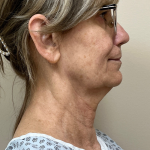 HourLift Before & After Patient #11031
