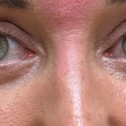 Blepharoplasty Before & After Patient #11036