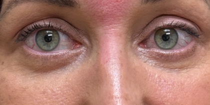 Blepharoplasty Before & After Patient #11036