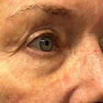 Blepharoplasty Before & After Patient #11058