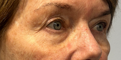 Blepharoplasty Before & After Patient #11058
