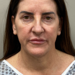 CO2 Laser Before & After Patient #11061