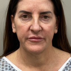 CO2 Laser Before & After Patient #11061