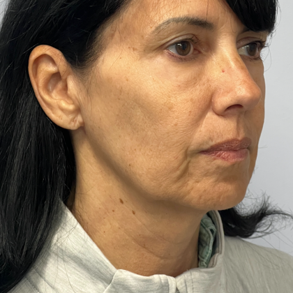 HourLift Before & After Patient #11067