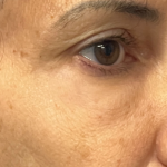 Blepharoplasty Before & After Patient #11070