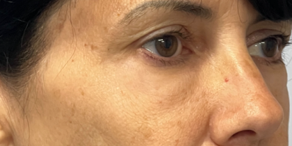 Blepharoplasty Before & After Patient #11070