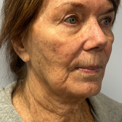 HourLift Before & After Patient #11049