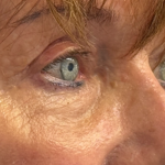 Blepharoplasty Before & After Patient #11058