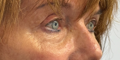 Blepharoplasty Before & After Patient #11058