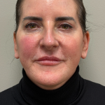 CO2 Laser Before & After Patient #11061