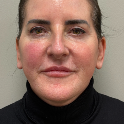 CO2 Laser Before & After Patient #11061