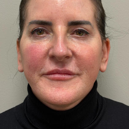 CO2 Laser Before & After Patient #11061