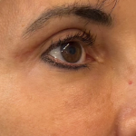 Blepharoplasty Before & After Patient #11070