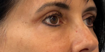 Blepharoplasty Before & After Patient #11070