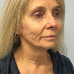 HourLift Before & After Patient #11064