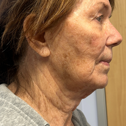 HourLift Before & After Patient #11049