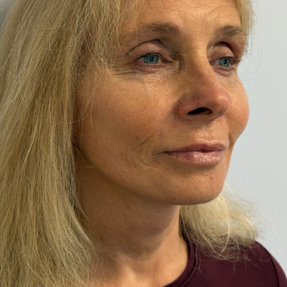 HourLift Before & After Patient #11064