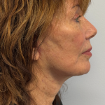 HourLift Before & After Patient #11049