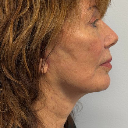 HourLift Before & After Patient #11049