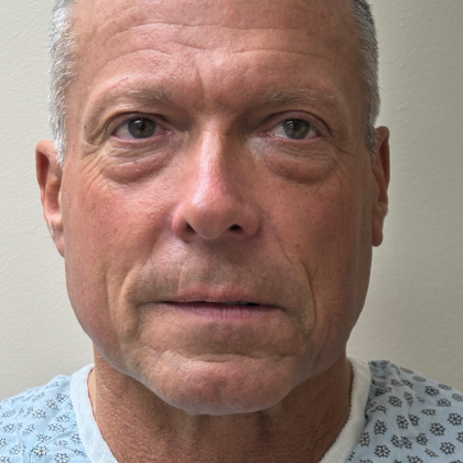 Upper Lift Before & After Patient #11130