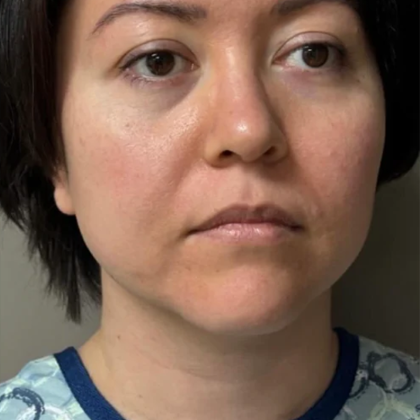 Upper Lift Before & After Patient #11129