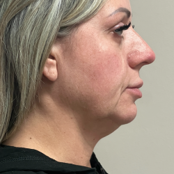 HourLift Before & After Patient #11091