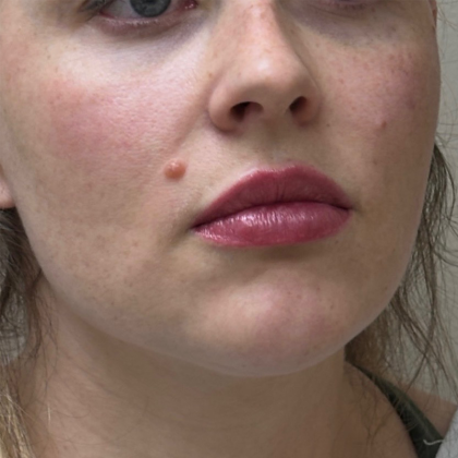 Upper Lift Before & After Patient #11128