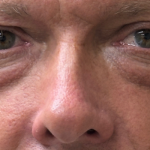 Blepharoplasty Before & After Patient #11105