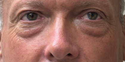 Blepharoplasty Before & After Patient #11105