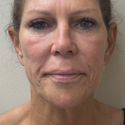 HourLift Before & After Patient #11112