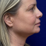 HourLift Before & After Patient #11118