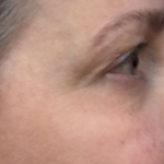 Blepharoplasty Before & After Patient #11121