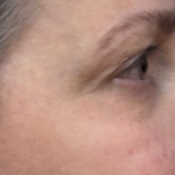 Blepharoplasty Before & After Patient #11121