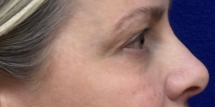 Blepharoplasty Before & After Patient #11121