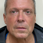 Upper Lift Before & After Patient #11130