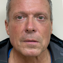 Upper Lift Before & After Patient #11130