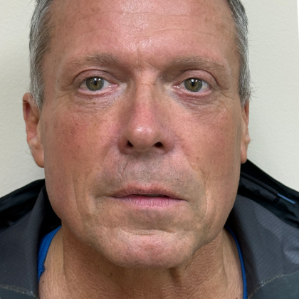 Upper Lift Before & After Patient #11130