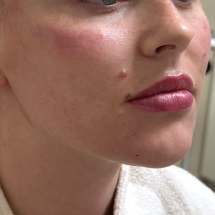 Upper Lift Before & After Patient #11128