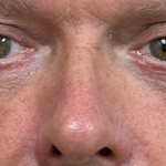 Blepharoplasty Before & After Patient #11105