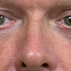 Blepharoplasty Before & After Patient #11105