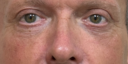 Blepharoplasty Before & After Patient #11105