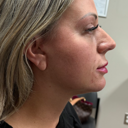 HourLift Before & After Patient #11091