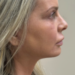 HourLift Before & After Patient #11118