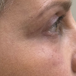 Blepharoplasty Before & After Patient #11121