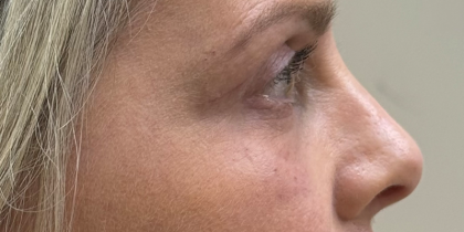 Blepharoplasty Before & After Patient #11121
