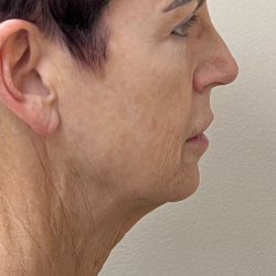 HourLift Before & After Patient #11094