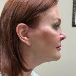 HourLift Before & After Patient #11117