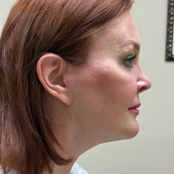 HourLift Before & After Patient #11117