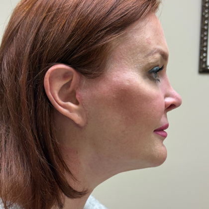 HourLift Before & After Patient #11117