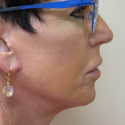 HourLift Before & After Patient #11094